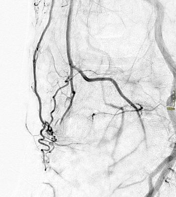 Fortgeschrittene Arthrose der Fußwurzel mit verstärkter Durchblutung bei krankhaft vermehrten Blutgefäßen