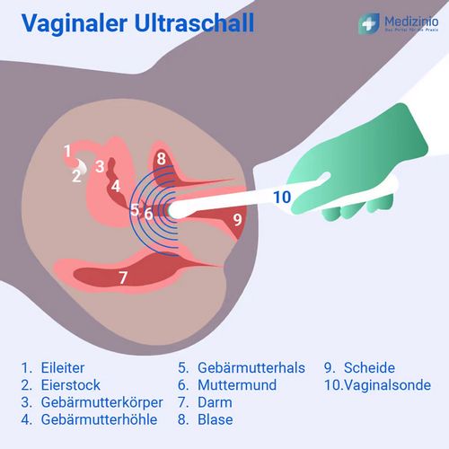 Die Beckenbodensonografie kann von außen (Unterbauch) oder wie hier schematisch gezeigt über die Scheide erfolgen (Bild: Vaginaler Ultraschall/Medizinio)