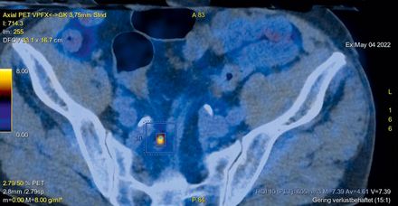 Mit dem neuen PET/CT lassen sich Metastasen (wie hier im Lymphknoten der Achsel; orange markiert) und Karzinome noch besser erkennen (