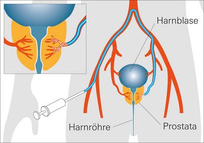 Schematische Darstellung der Prostata-Arterien-Embolisation (Quelle: Universitätsklinikum Würzburg)