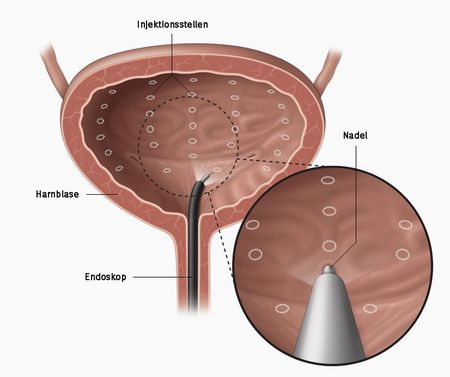 Bei der Botox-Therapie werden durch ein Endoskop mehrere kleine Injektionen von Botulinumtoxin in den Blasenmuskel gesetzt