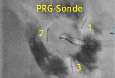 Zentral eingelegte PRG-Sonde nach Abschluss des Eingriffs (mit den drei Fadenankern zur Fixierung des Magens)