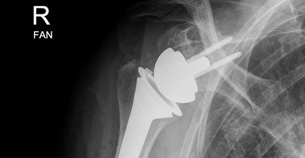 Die inverse Schulterprothese wurde bei der Operation zementfrei im Knorpel verankert