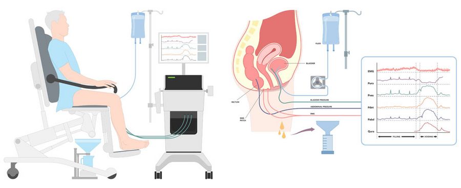 Die Urodynamische Messung (Zystometrie) dazu dient, die Funktion der Harnblase zu überprüfen und mögliche Störungen zu erkennen