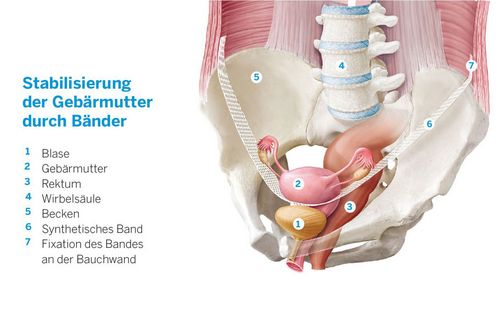Durch eine Senkungsoperation lassen sich die betroffenen Organe (hier die Gebärmutter) mithilfe von Bändern oder Netzen wieder anheben und stützen